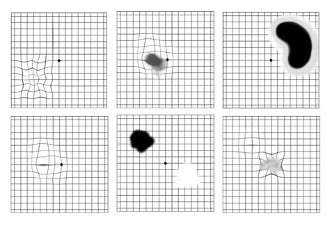 Amsler Grid: How to Identify Vision Changes.